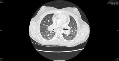 Chest radiographs in the patient showed diffuse linear opacities at the base of the lungs