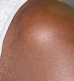Swollen Erythematous Left Shoulder